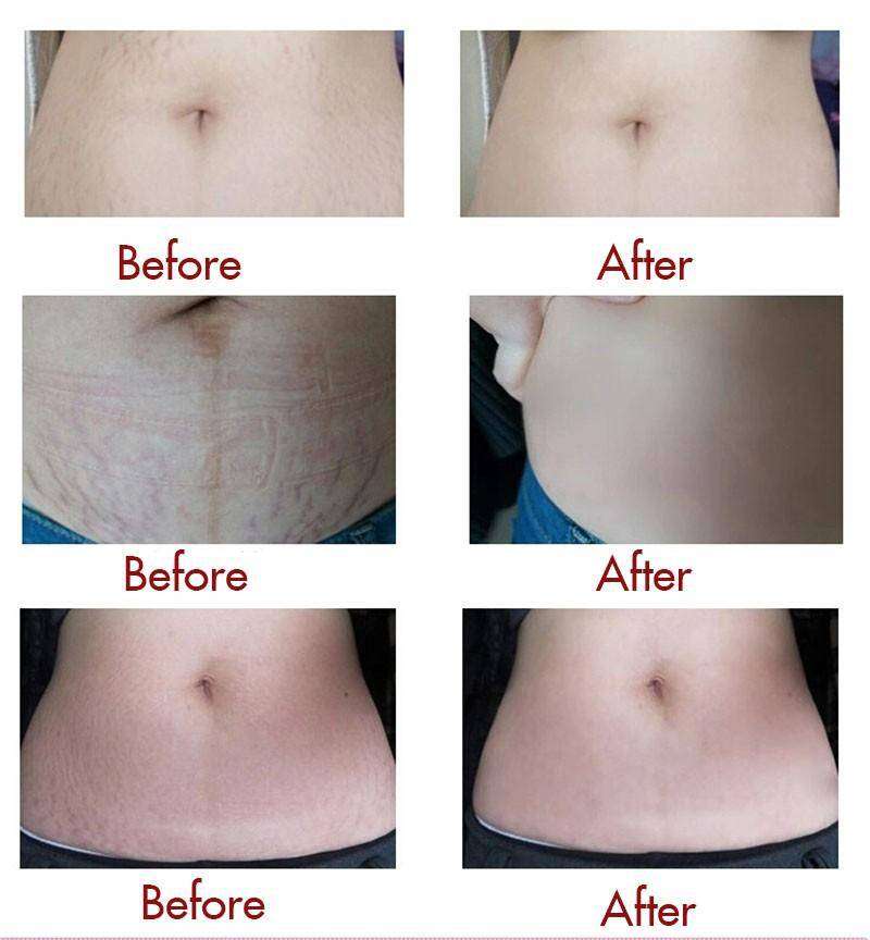 Snail Stretch Marks Cream