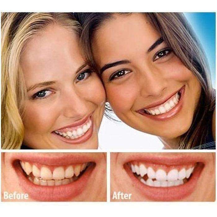 White Light Teeth Whitener