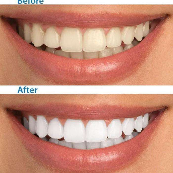 Miracle Teeth Whitener x2