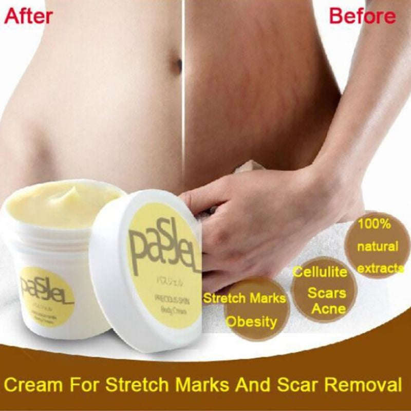 Stretch Mark Removal