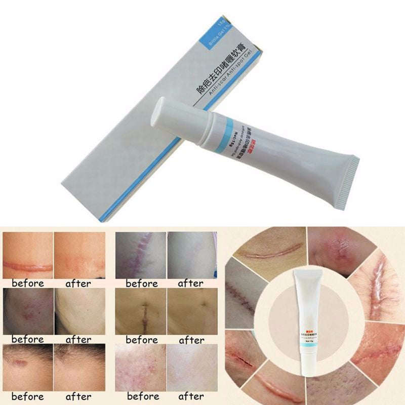Scar Removal Cream
