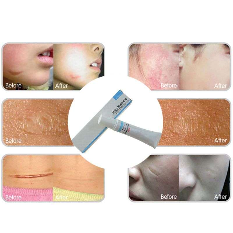 Scar Removal Cream