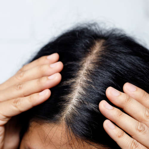 Seascalp Solution (For Dandruff) - 100ml