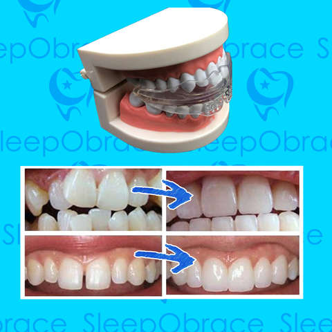 Sleeping Braces - Align your Teeth and improve your Jawline & Face Structure