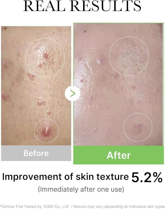 Medicube Exosome Cica Tea Tree Ampoule for Sensitive Skin