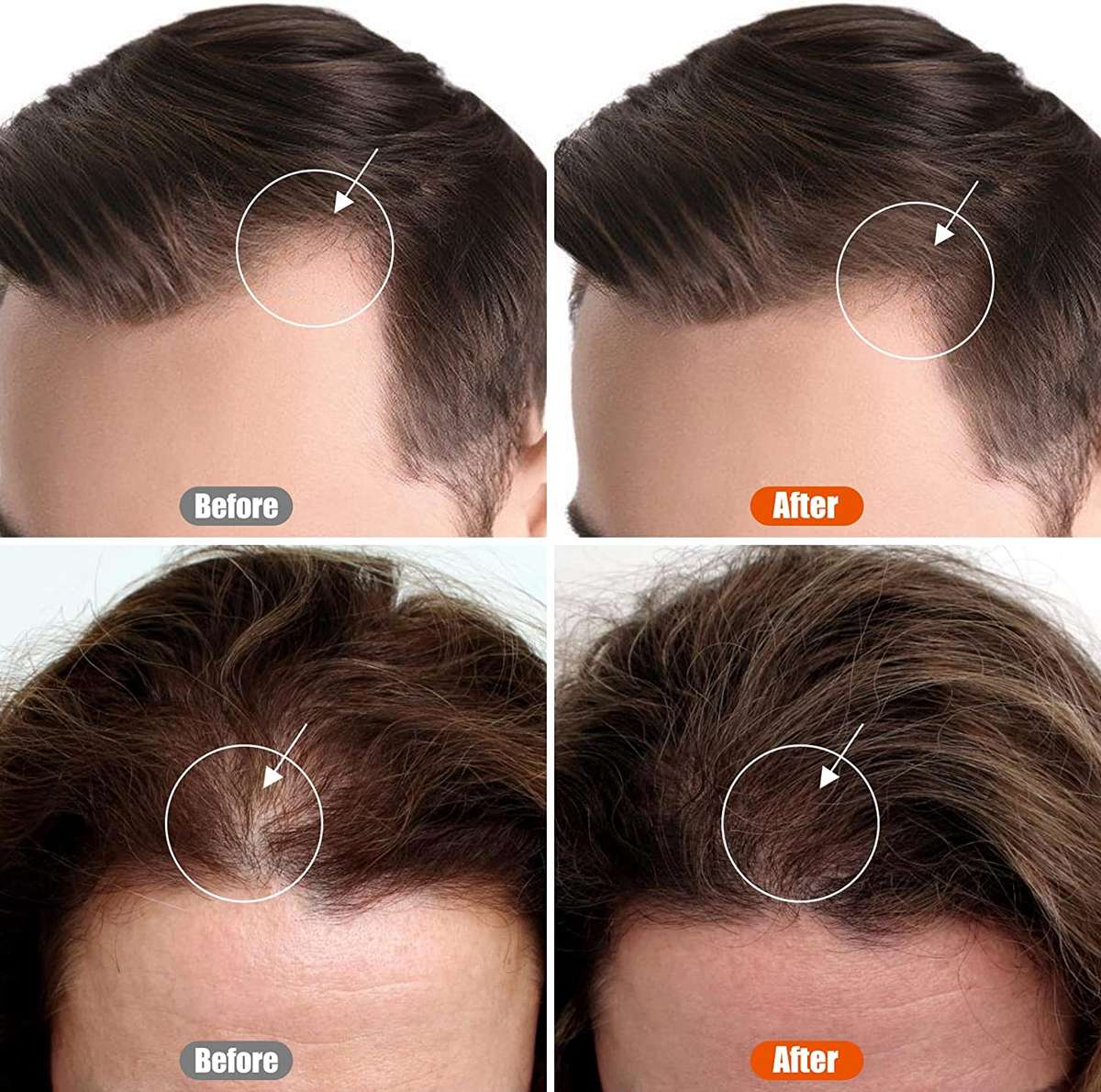 Mens Derma Roller for Beard Growth (0.5mm)