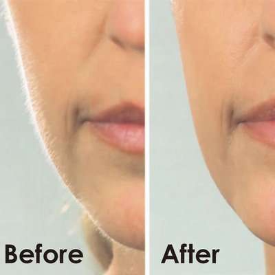 Igia Facial Dermaplaner Hair Remover