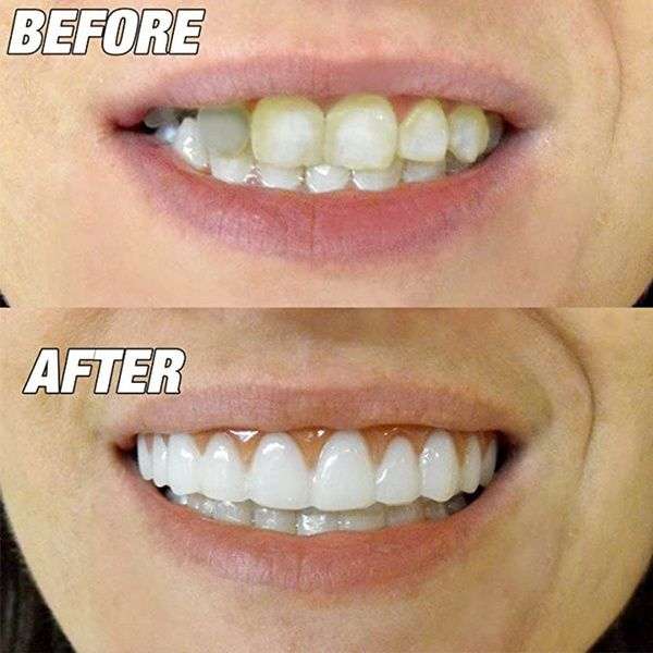 Perfect Smile - Incredible and Instant Reusable and Removable Veneers