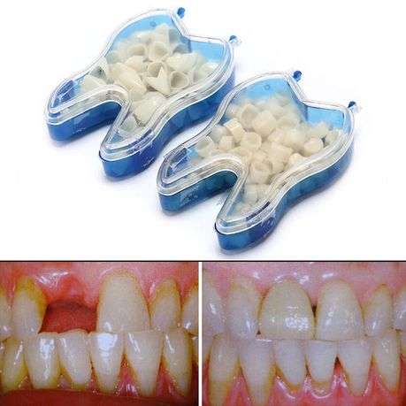 Temporary crowns, Teeth veneers Anterior & Posterior (front & back teeth)