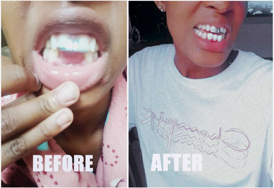 Perfect smile Cut-Able teeth veneers, suitable for top or bottom Cut & Use