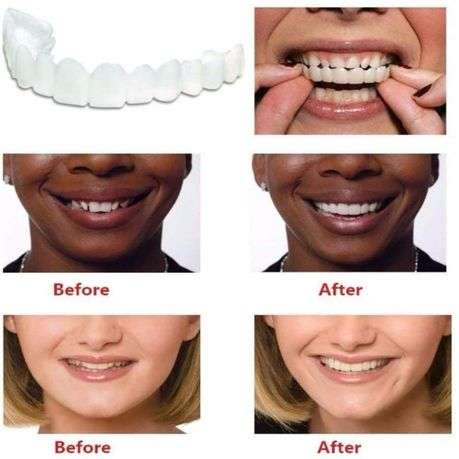 Upper and lower teeth silicone veneers