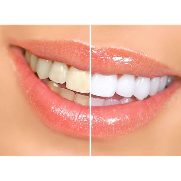 Miracle Teeth Whitening Paste