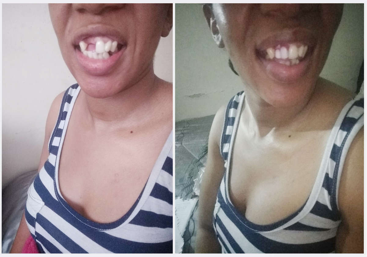 Perfect smile Cut-Able teeth veneers, suitable for top or bottom Cut & Use