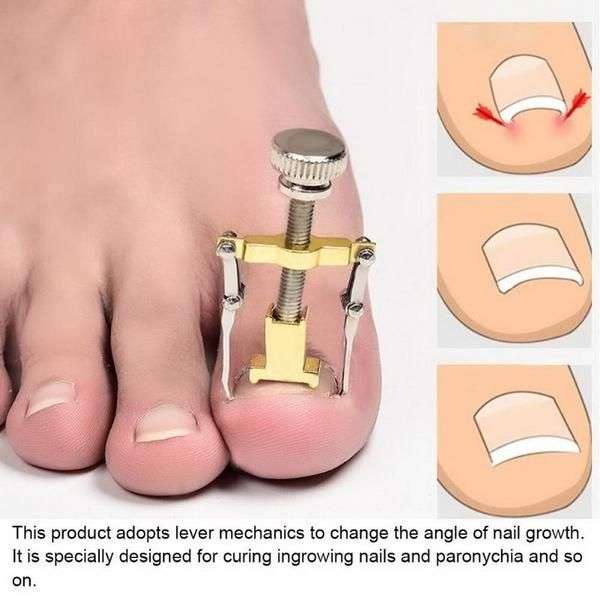 Professional Ingrown Toe Nail Correction