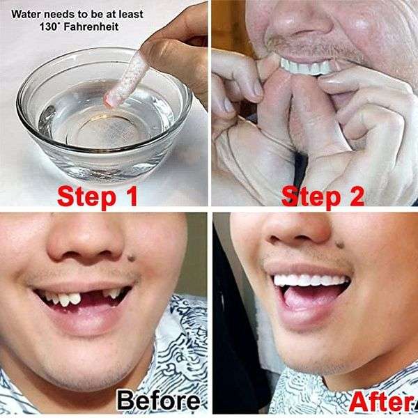 Perfect Smile - Incredible and Instant Reusable and Removable Veneers