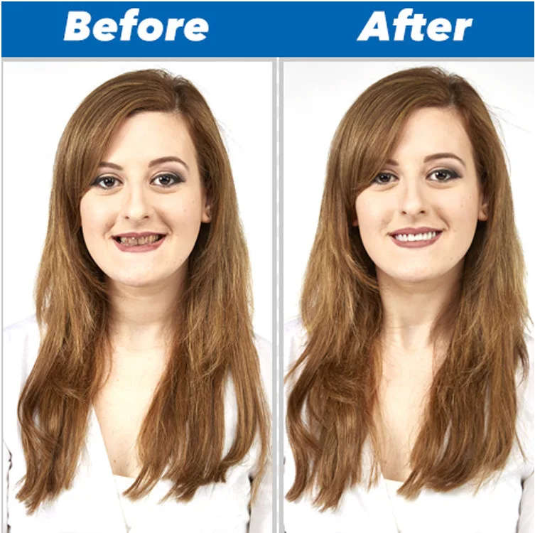 Perfect Smile Veneers