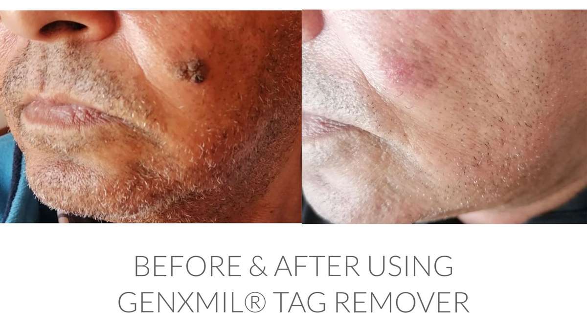 Genxmil Tag Remover
