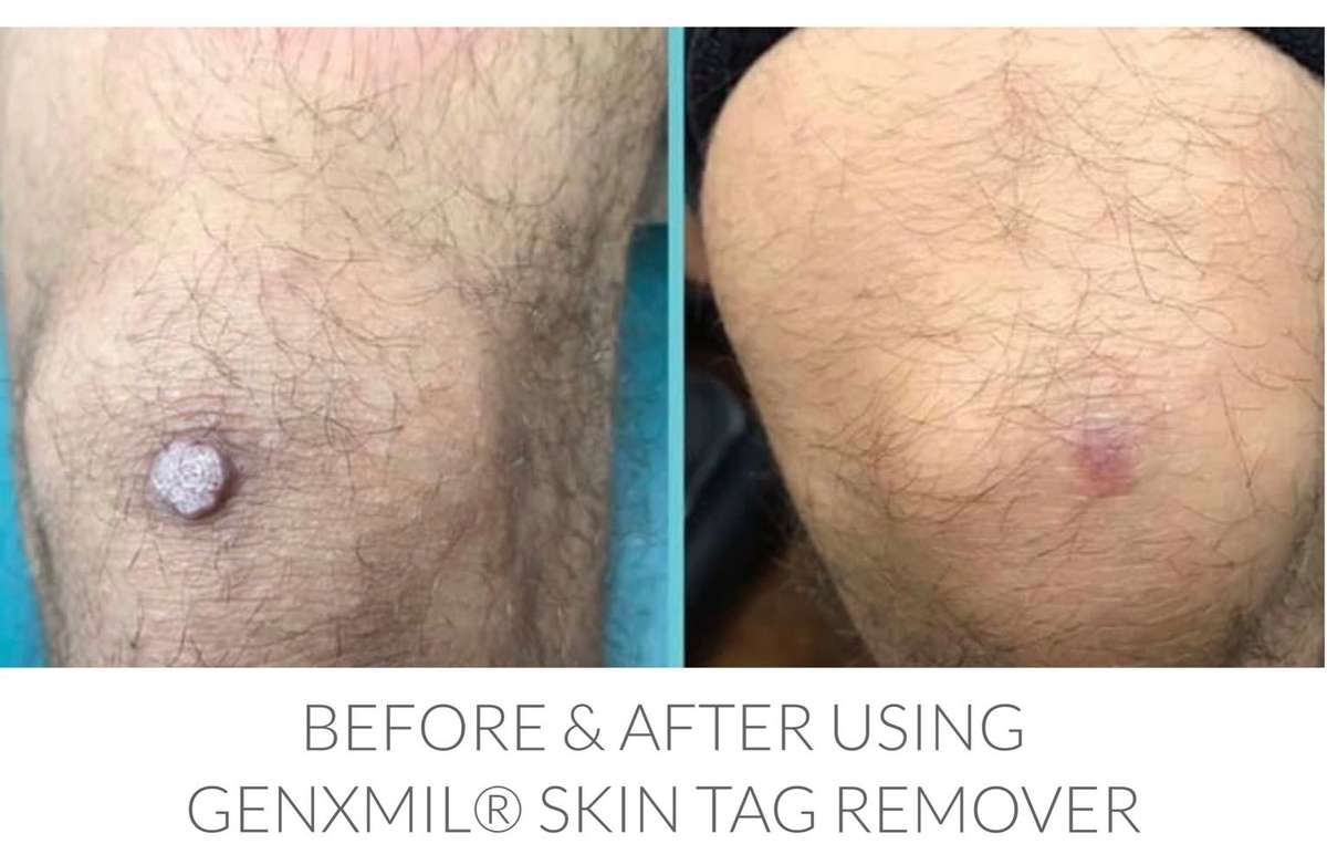 Genxmil Tag Remover