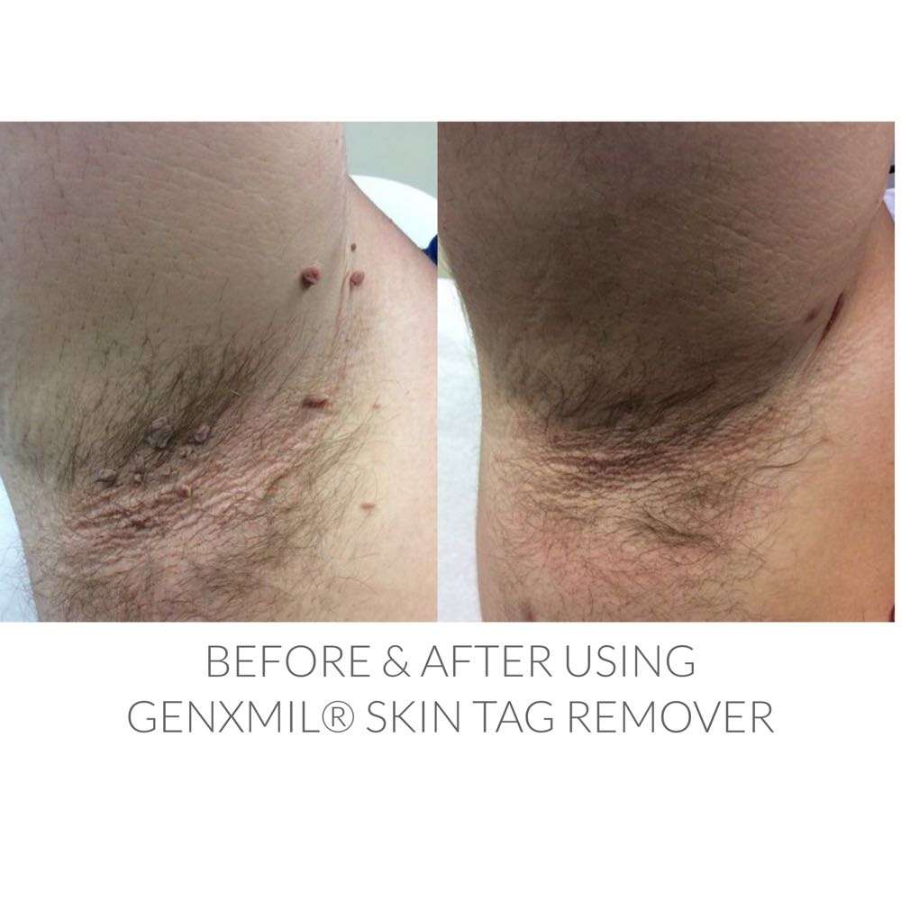 Genxmil Tag Remover