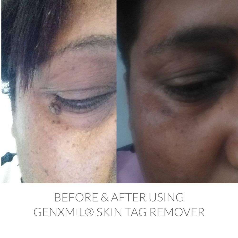 Genxmil Tag Remover