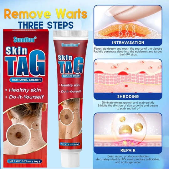 Skin tags removal Cream