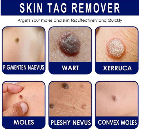 Skin tags removal Cream