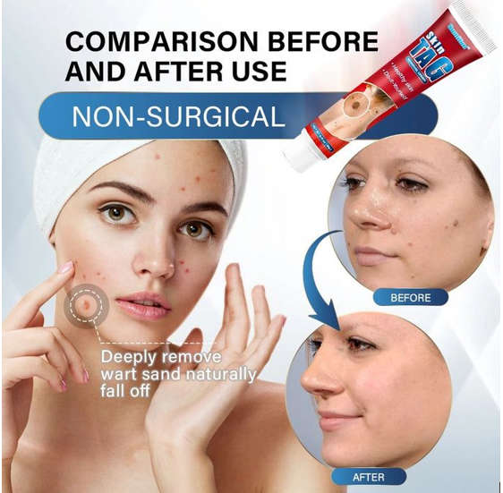 Skin tags removal Cream