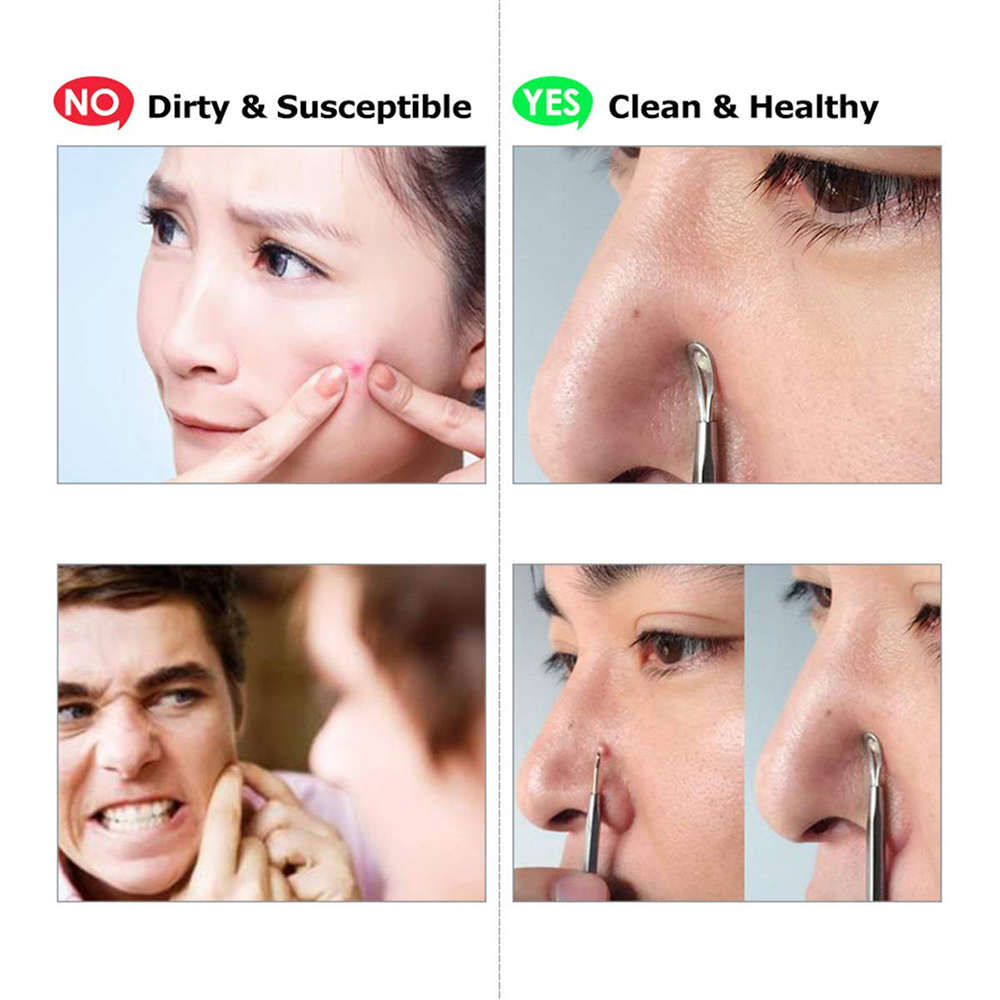 Blackhead Remover Tool Kit - 7 Piece