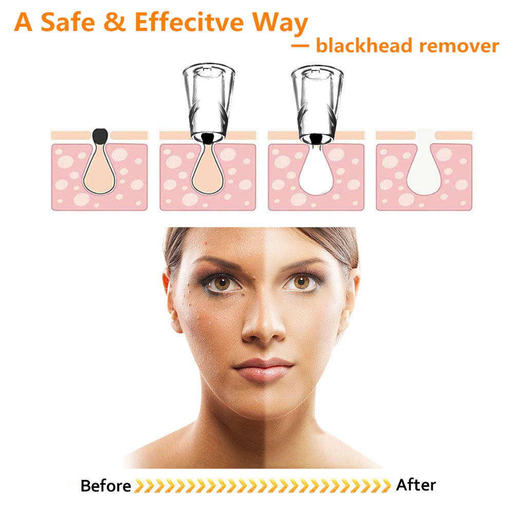 Blackhead Remover Pore Vacuum Cleaner with Three Sucker Heads