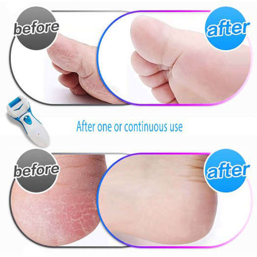 Electric Callus Remover Rechargeable Micro Pedi Foot File Shaves Dead Hard Cracked Skin on Feet