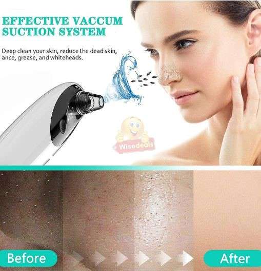 10 X Magnification HD Camera and LED lights Blackhead remover