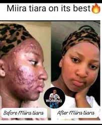 MIIRA-TIARA - Stem Cell Therapy For Skin Care