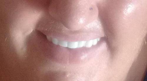 Instant smile kits