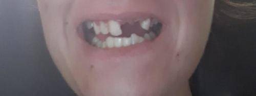 Instant smile kits