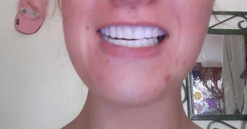 Instant smile kits