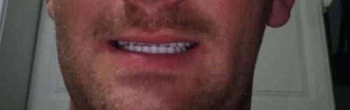 Instant smile kits