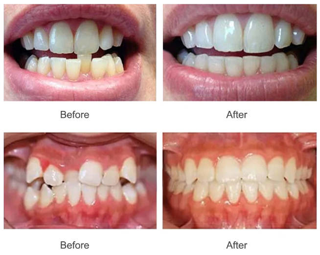 Teeth Aligner - Complete 3 stage Set - Adult - invisible