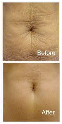 Ultrasonic Cavitation Machine