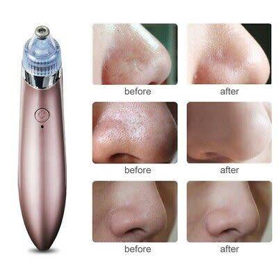 ACNE PORE SUCTION CLEANER