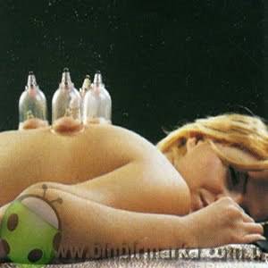 CHINESE CUPPING THERAPY --- PULL VACUUM APPARATUS