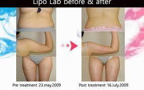 SPECIAL! Buy 3 Get 1 FREE!!! 1 LipoLab slimming injection for belly fat.0,5 ml.PPC concentrate.