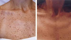 #1 Skin Whitening Glutathione SPF50++ cosmetic soap 70g.Pure Gluta,Vit B3+E+C,rice milk.NO lye.