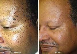 100g Dark spot remover Soap .skin brightennig.Whitenning.Seaweed extract ,Vitamin B3 anti acne