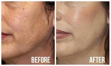 GlutaWhite Skin whitening brightening X 30 1500000 mg. Glutathione V-face lightening tightening