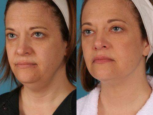 1pcs 2N V-face mask. 1cm Lifting in 1 treatment.Whitening,reduction double chin,skin tightening