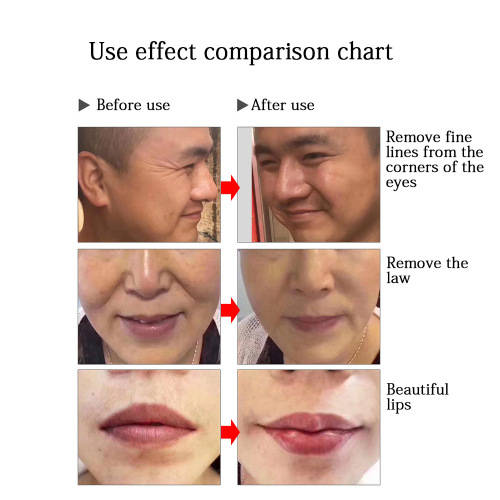 Hyaluron dermal pen/gun no needle face skin filler 0.3ml+8 joint+hyaluronic acid 10 vials anti-aging