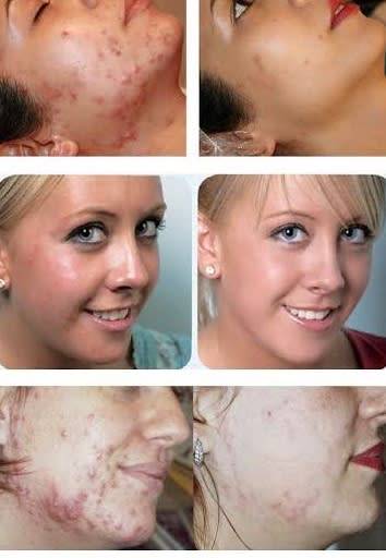 Face Chemical Peel 40% lactic Acid Solution