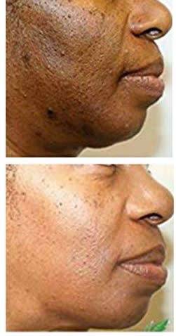 Face Chemical Peel 40% lactic Acid Solution