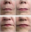 Laser Therapy : Cellulite- Wrinkles - Hair Growth - Acne (Regeneration of New Cells)