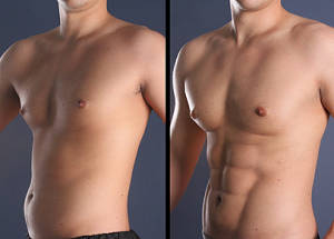 Laser Lipo x 4 Sessions at Brazen Beauty Bar - Randburg, Johannesburg